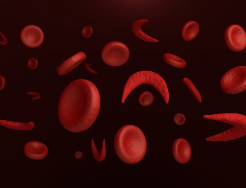 How is Sickle Cell Disease diagnosed?