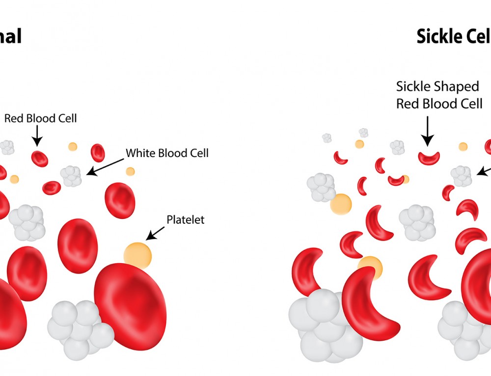 Sickle Cell anemia. Эритроциты ДНК. Sickle Cell anemia image. Ядерные эритроциты птицы.